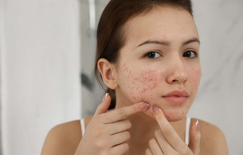 Các bước skincare cho da mụn nên thực hiện nhẹ nhàng, tránh chà xát mạnh 