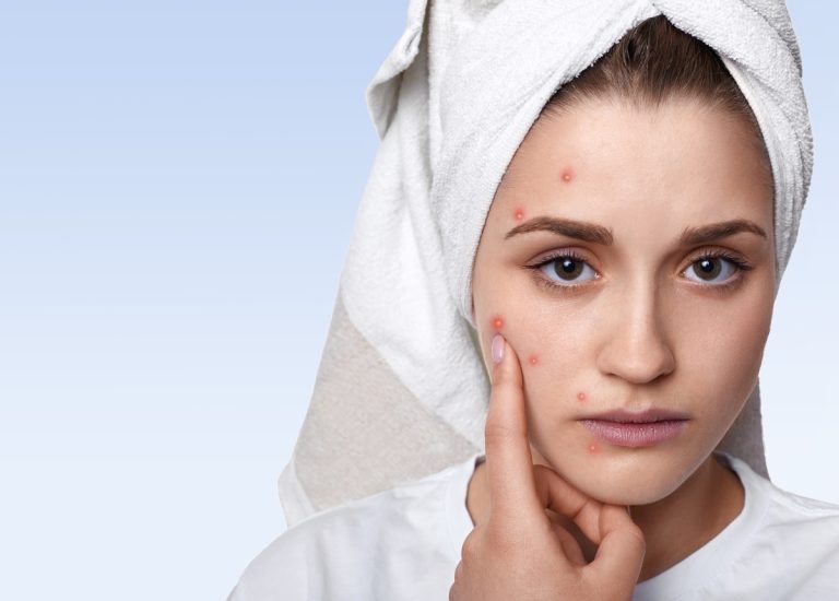 Mụn trứng cá: Nguyên nhân, cách điều trị dứt điểm an toàn, hiệu quả