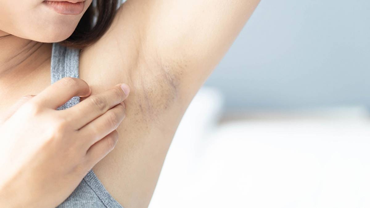 Tẩy lông sai phương pháp có thể gây tổn thương da 