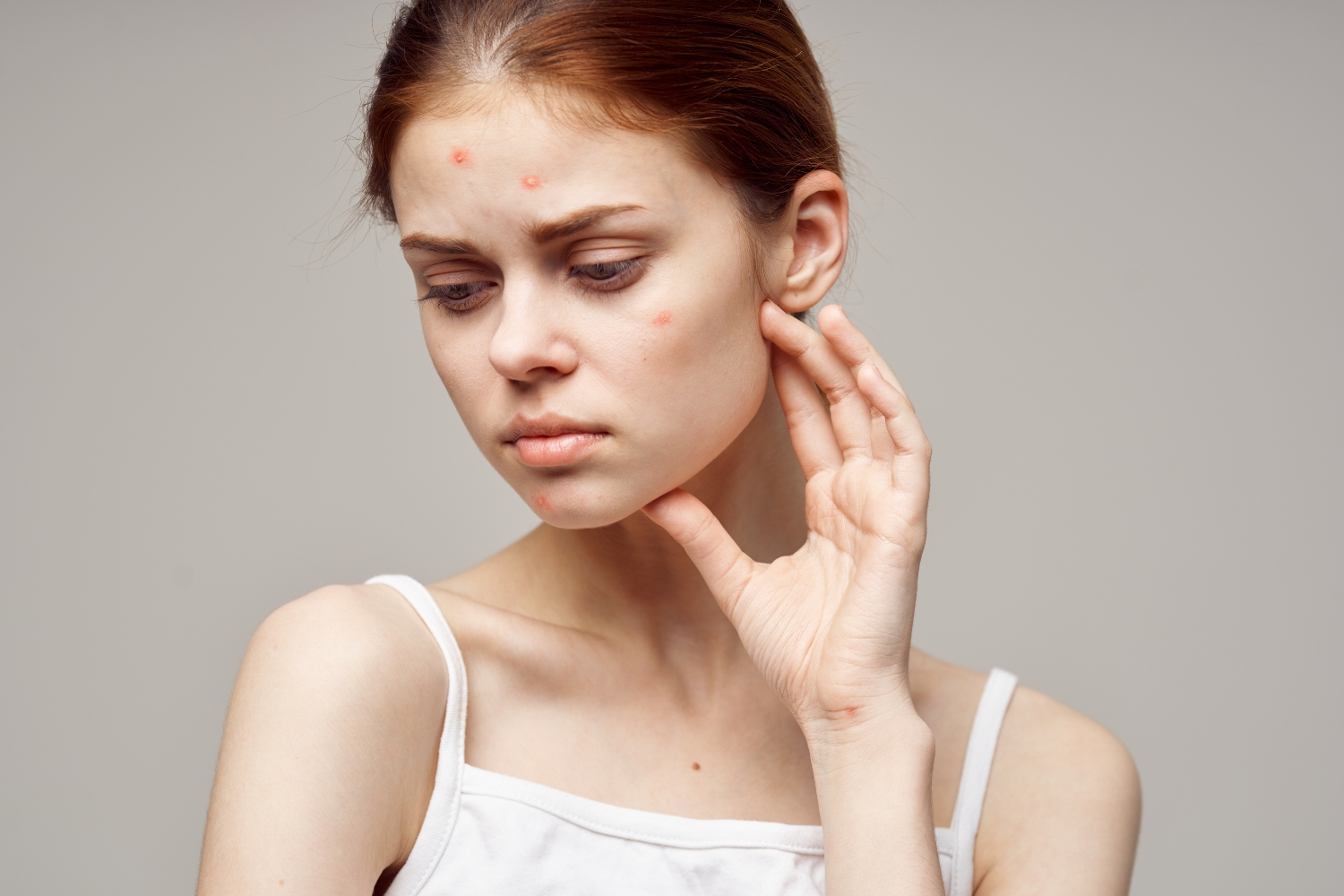 Mụn bọc thường xuất hiện ở vị trí thái dương