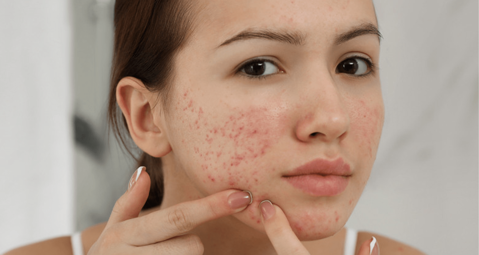 Tình trạng mụn có thể trở nên nghiêm trọng hơn nếu nặn mụn sai cách