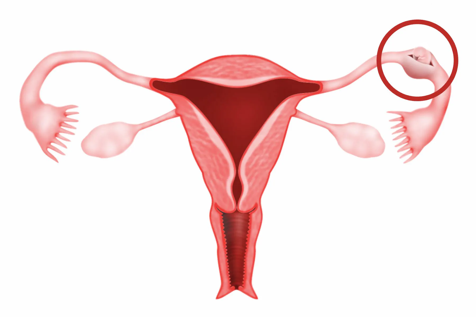 Có thai ngoài tử cung cũng tạo ra hiện tượng ra máu 