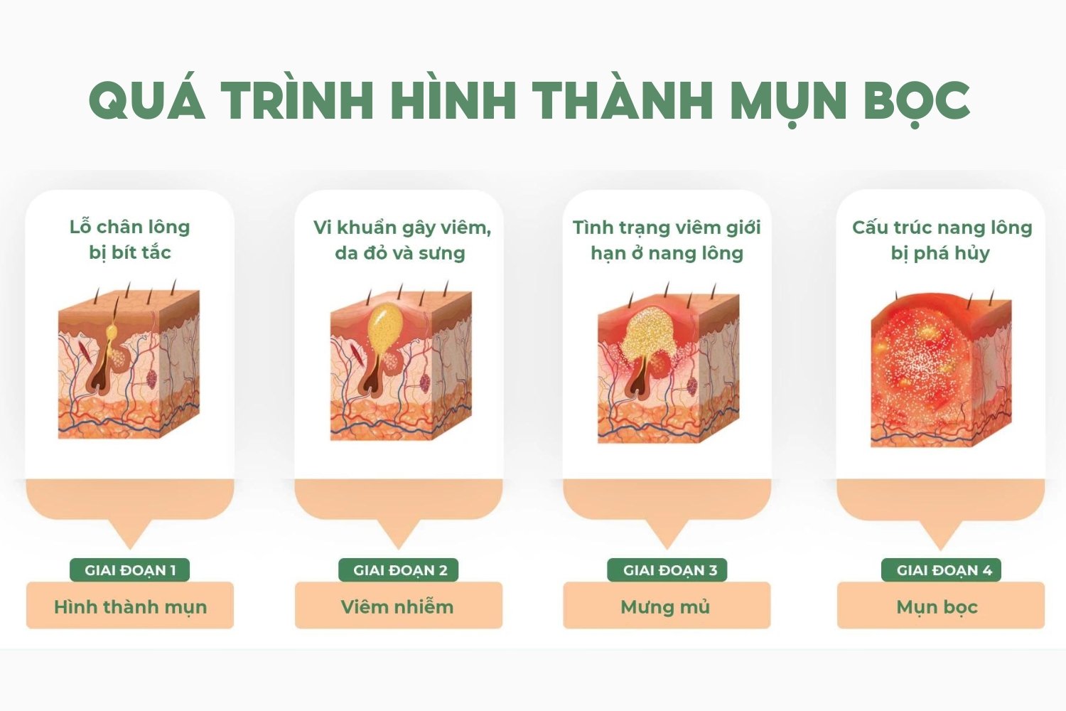 Tóm tắt quá trình hình thành mụn bọc