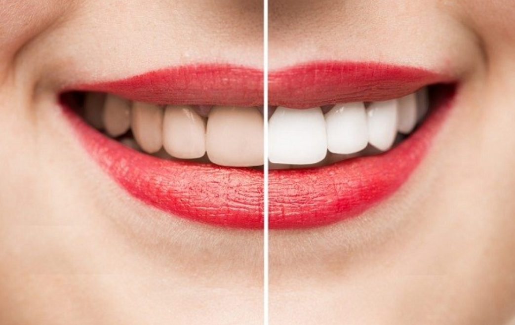 Tẩy trắng răng để lấy lại màu trắng sáng tự nhiên cho răng 