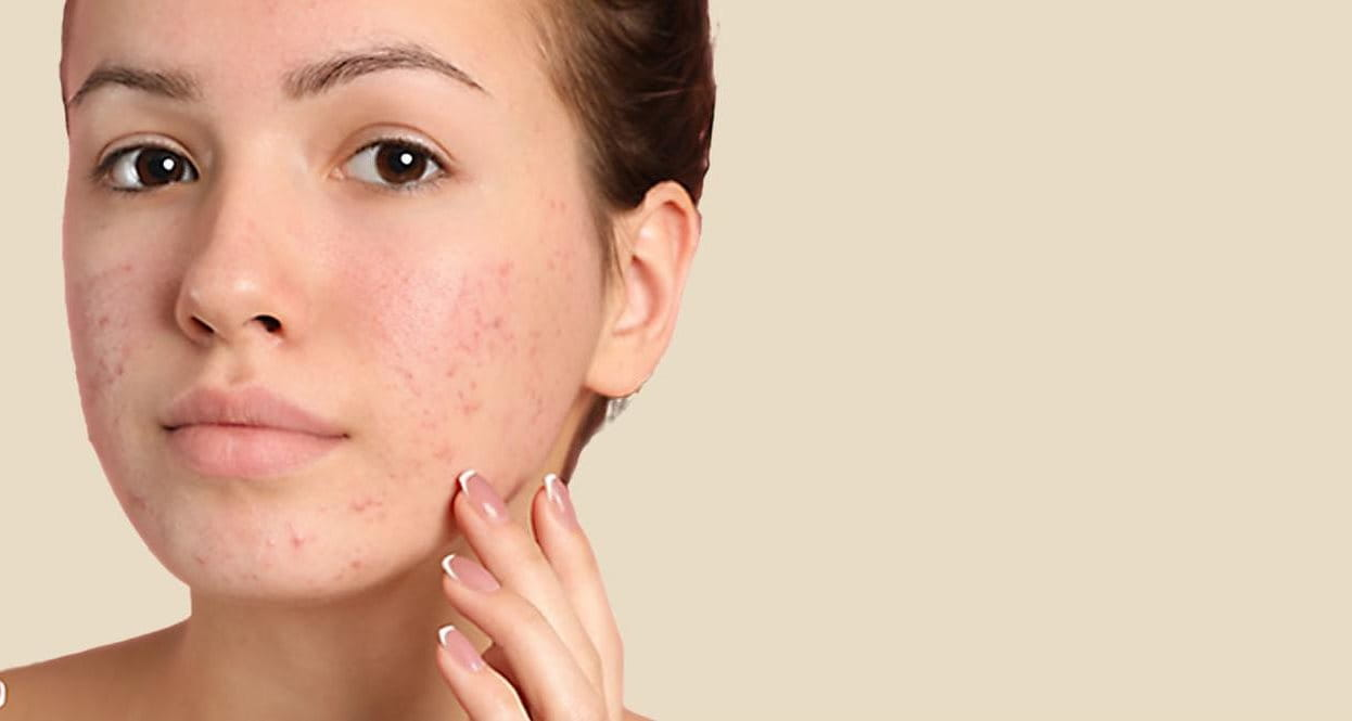 Tầm quan trọng của việc chăm sóc da sau khi nặn mụn 