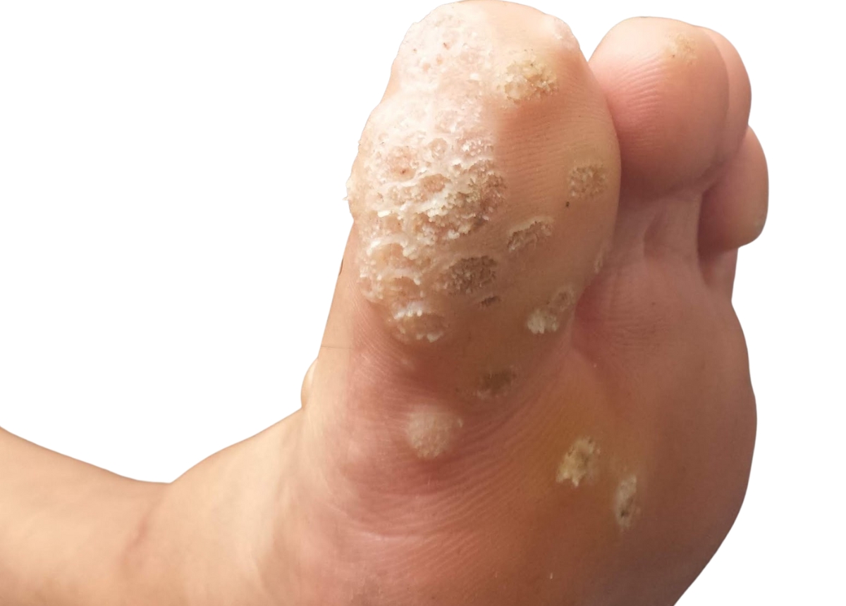 Mụn cóc đẩy lớp da non lên và gây nứt móng chân