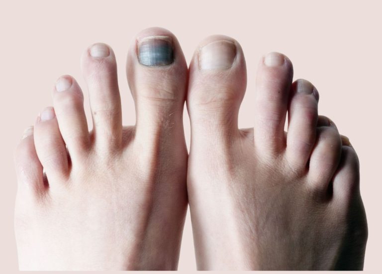 Vì sao móng chân bị đen? Cách điều trị tại nhà