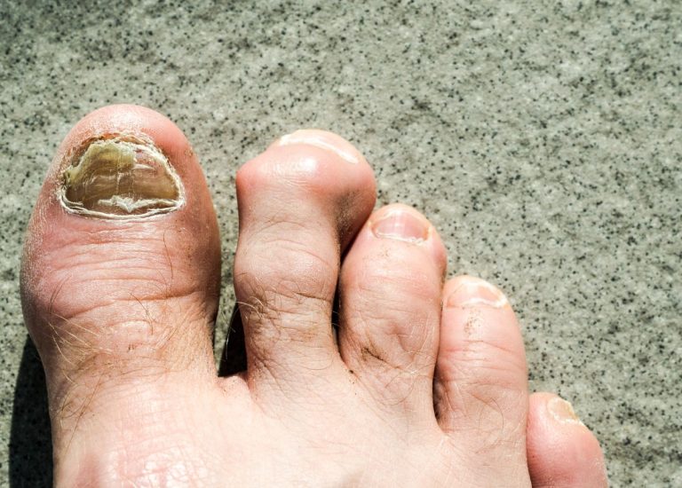 Nguyên nhân móng chân bị hư và cách xử lý dứt điểm 