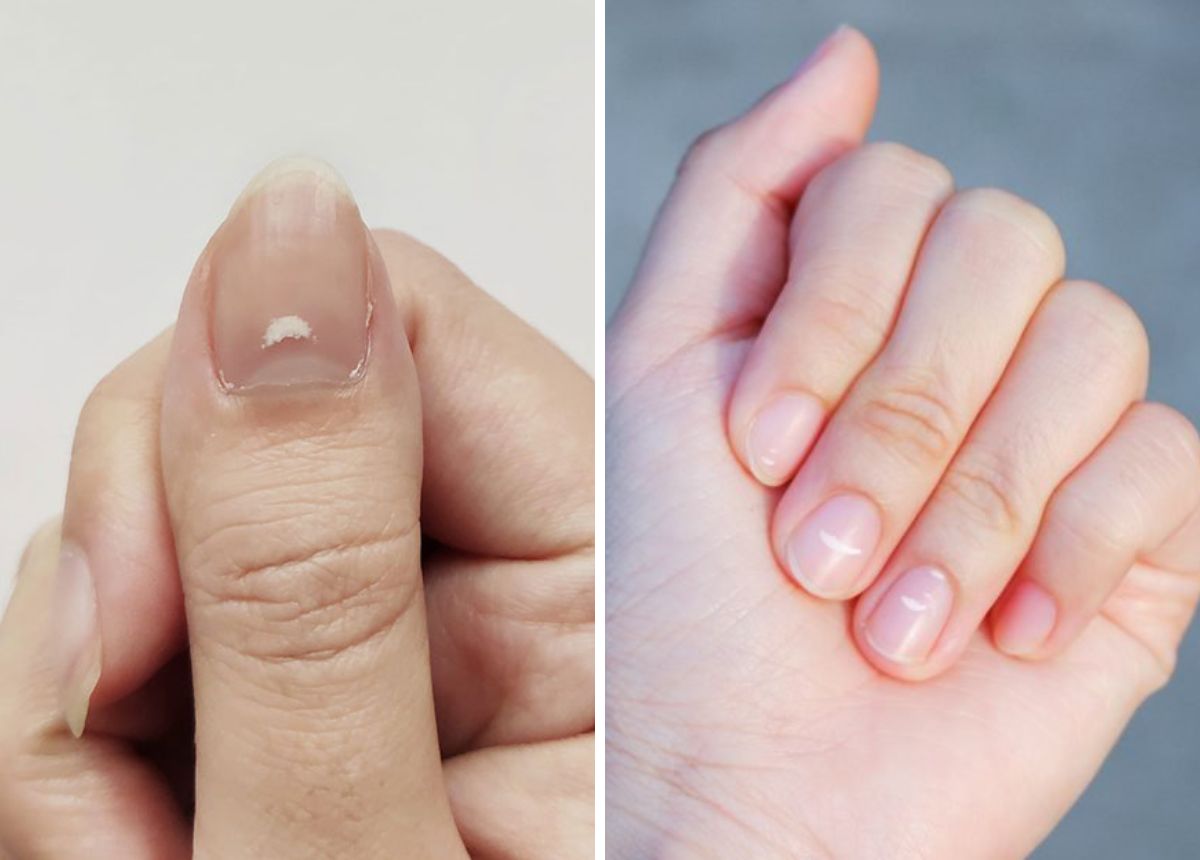 Nguyên nhân móng tay có đốm trắng bạn cần biết | TIKI Nguyên nhân móng tay có đốm trắng bạn cần biết | TIKI