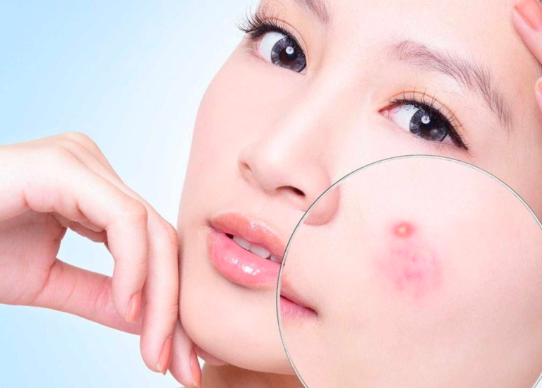 Nguyên nhân gây mụn bọc, cách điều trị mụn bọc an toàn, hiệu quả