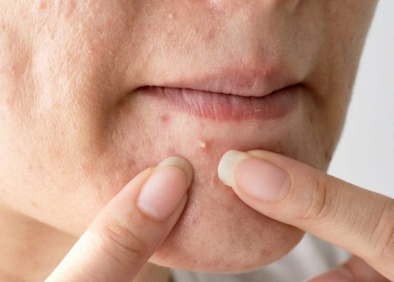 Mụn đầu trắng là gì? Nguyên nhân và cách trị mụn đầu trắng