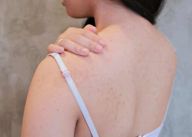 Nguyên nhân và cách trị mụn lưng cấp tốc