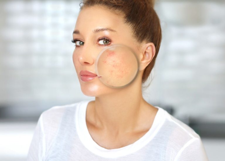 Phương pháp điều trị sẹo rỗ dứt điểm, an toàn 