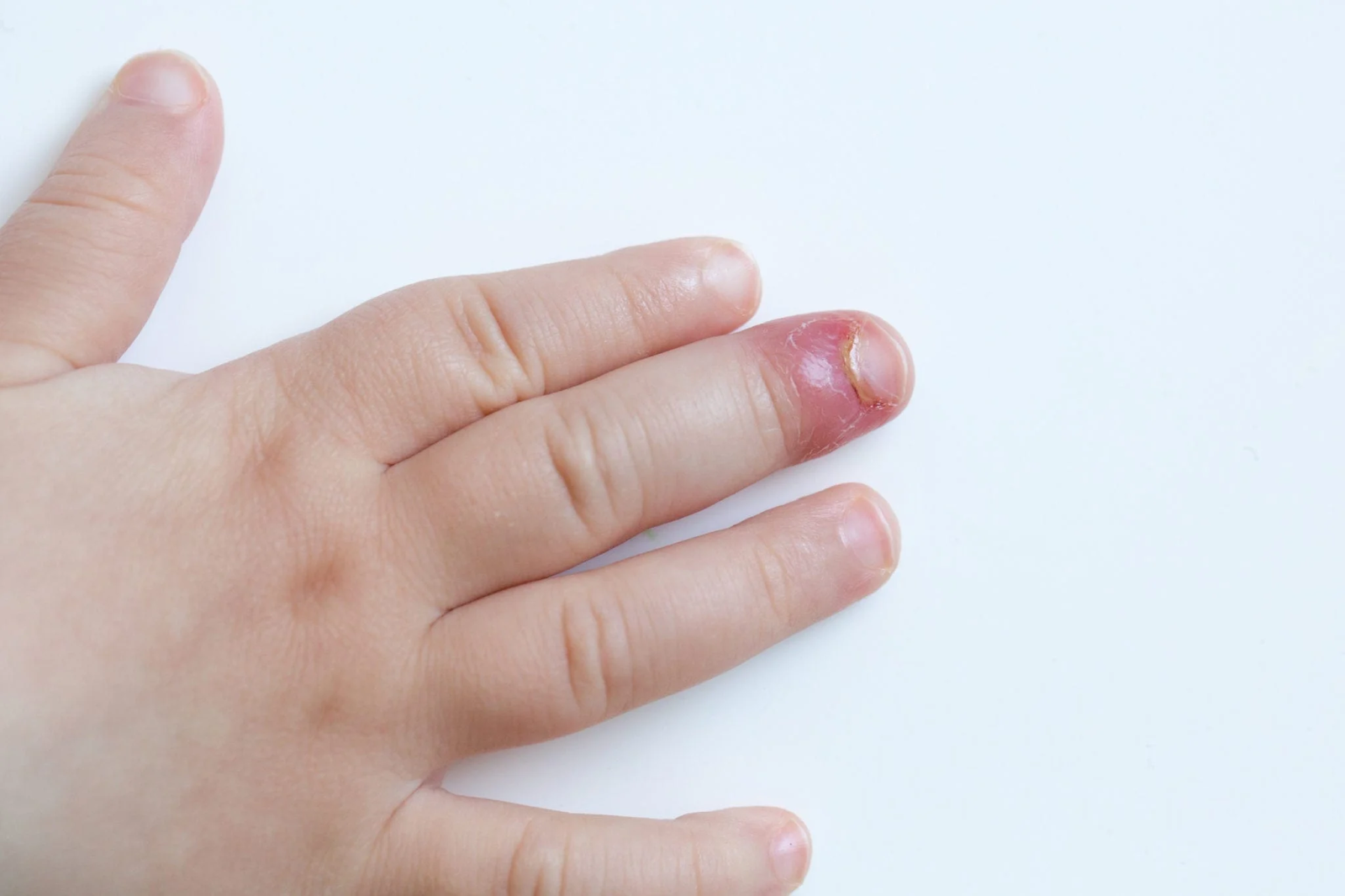 Trẻ bị xước móng rô mưng mủ do sự xâm nhập của vi sinh vật gây hại