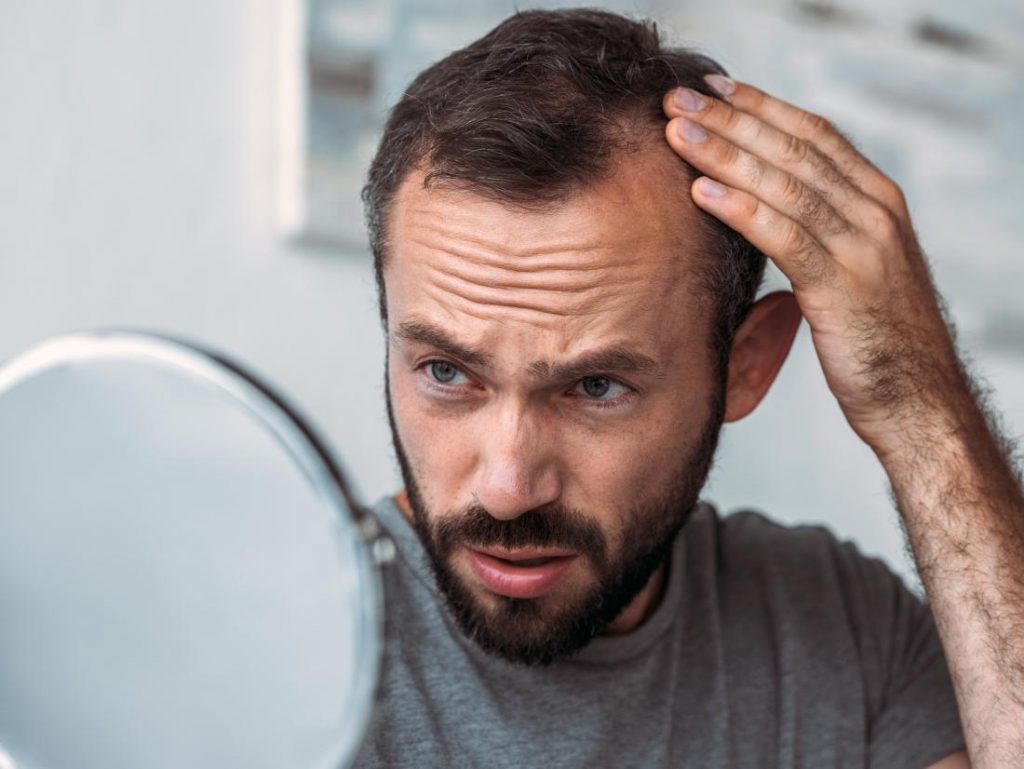 Rụng tóc nhiều gây hói đầu là nỗi lo lắng của “đấng mày râu”