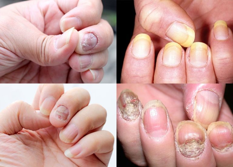 Hướng dẫn trị vảy nến móng tay tại nhà hiệu quả