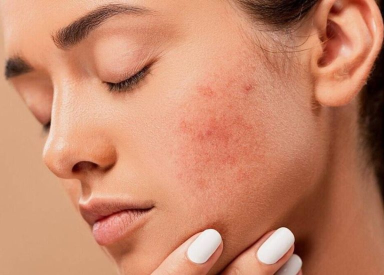 Viêm da dị ứng: Nguyên nhân và cách chữa viêm da dị ứng