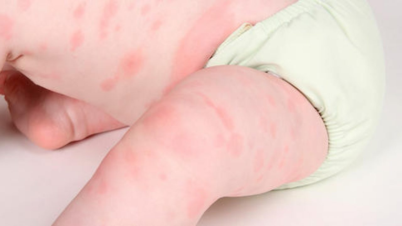 Viêm da thường xuất hiện nhiều ở trẻ sơ sinh từ 5-6 tuần tuổi 