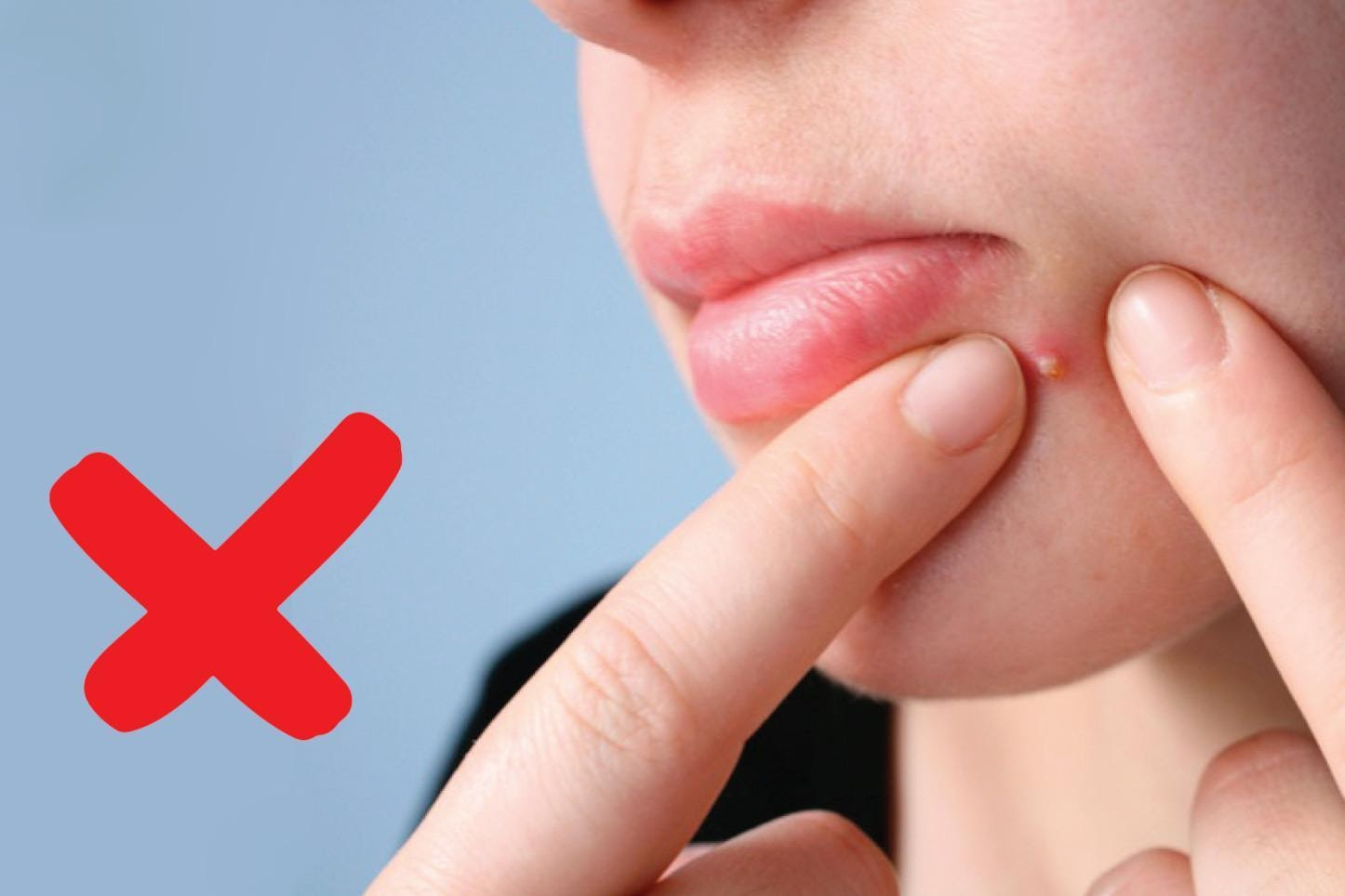 Không nên tiếp tục nặn mụn, cản trở quá trình phục hồi các vết thương