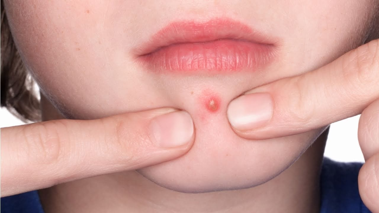 Các vết mụn có thể bị nhiễm trùng nếu không được nặn đúng cách