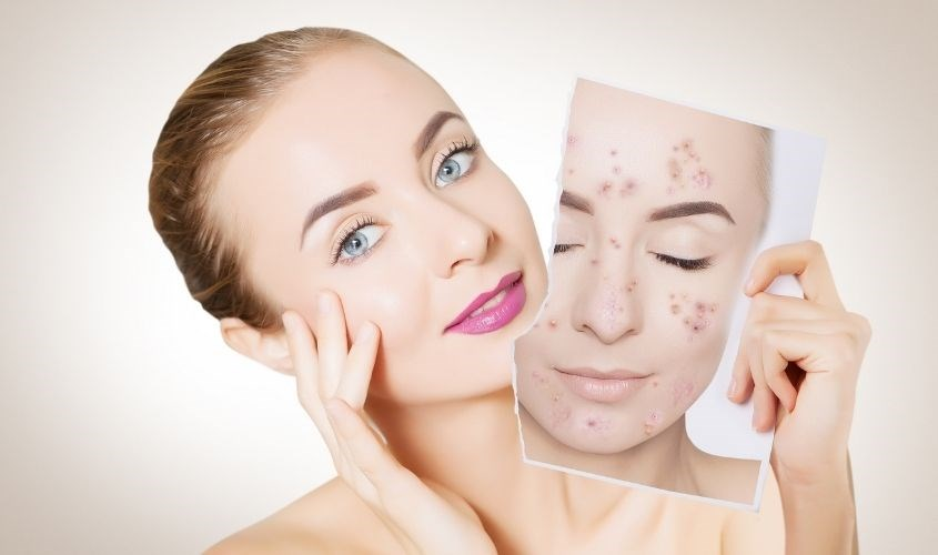Rửa mặt bằng nước muối sinh lý hỗ trợ điều trị mụn trứng cá