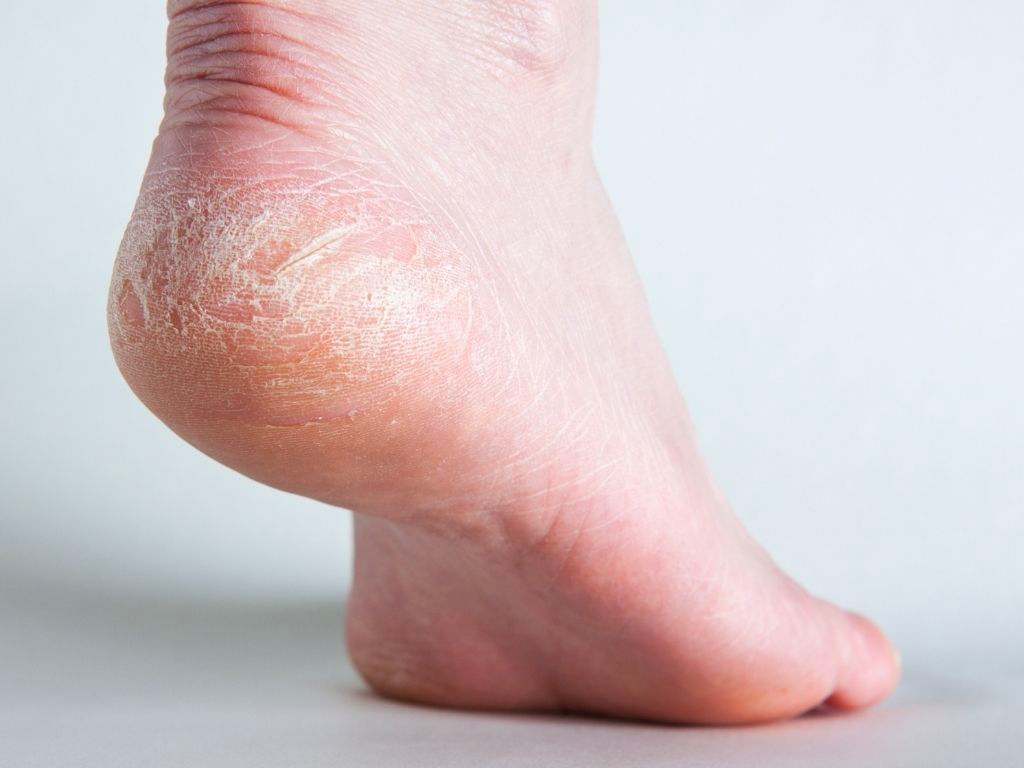Thời tiết hanh khô cũng là một trong những nguyên nhân khiến gót chân bị nứt 