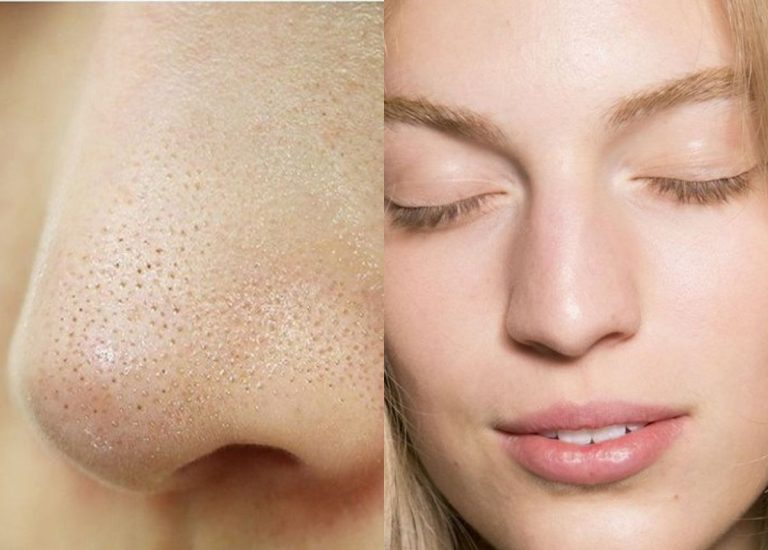 Nguyên nhân và cách trị mụn cám hiệu quả, tại nhà