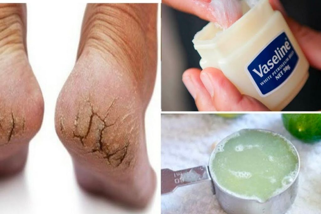Sử dụng vaseline hàng ngày để giữ cho da mềm mại và tránh tình trạng nứt gót chân tái phát.