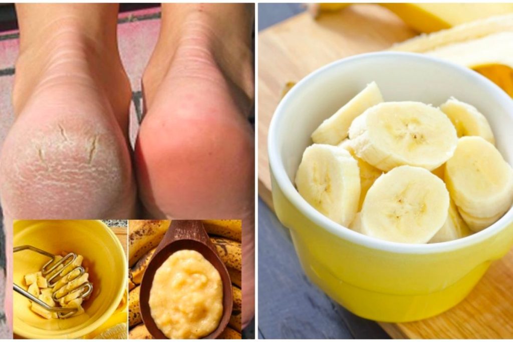 Trị nứt gót chân bằng chuối và bơ đơn giản