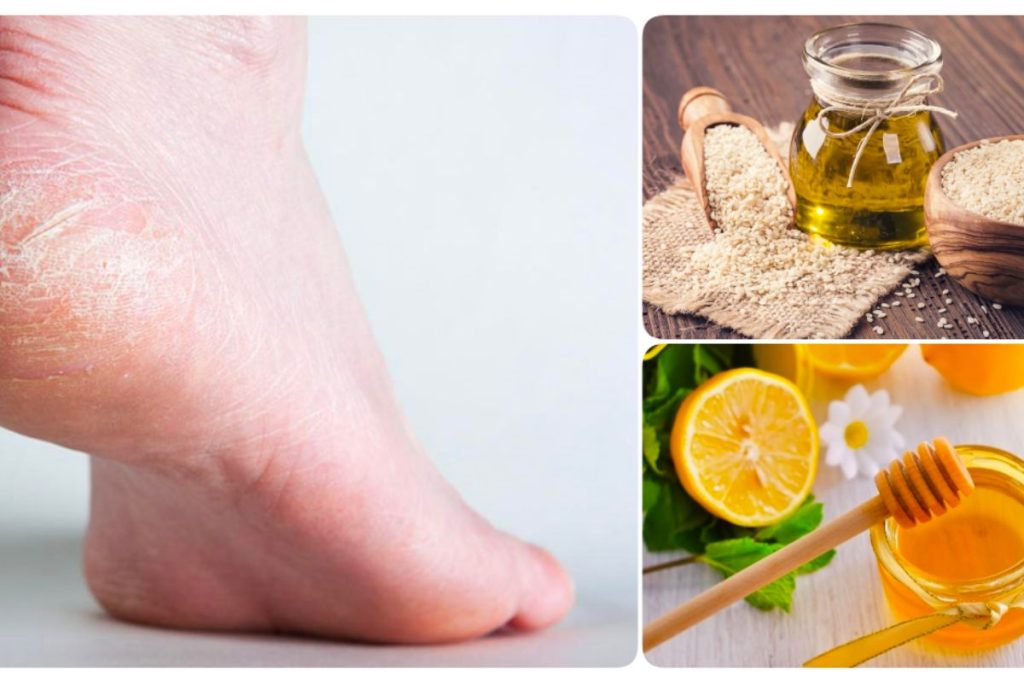 Phương pháp trị nứt gót chân bằng mật ong và yến mạch