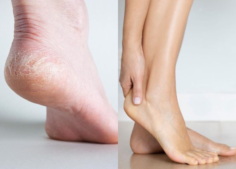 18 Cách trị nứt gót chân tại nhà, hiệu quả, đơn giản nhất