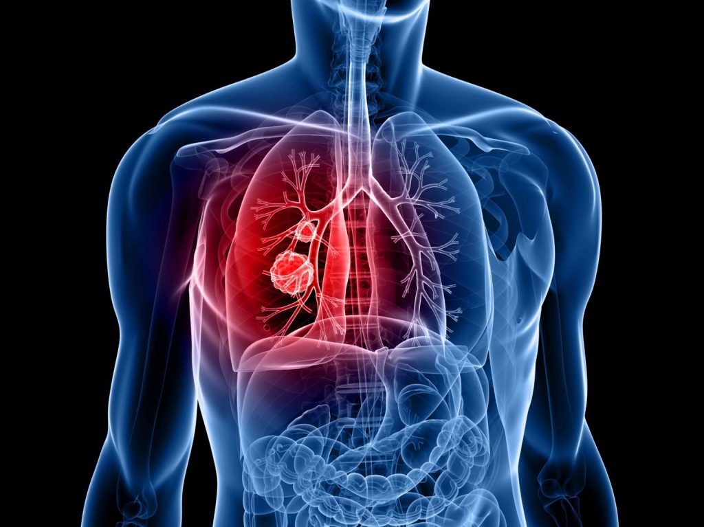 Táo giúp phòng ngừa bệnh ung thư phổi