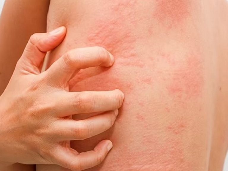 Cách chữa dị ứng mẩn ngứa tại nhà, an toàn, hiệu quả