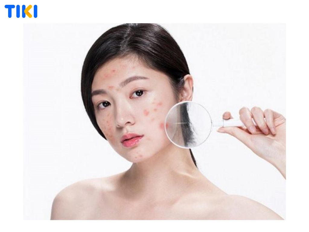 Chăm sóc da mặt sau khi nặn mụn có quan trọng hay không? 

