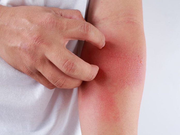 Các loại thuốc dị ứng thời tiết