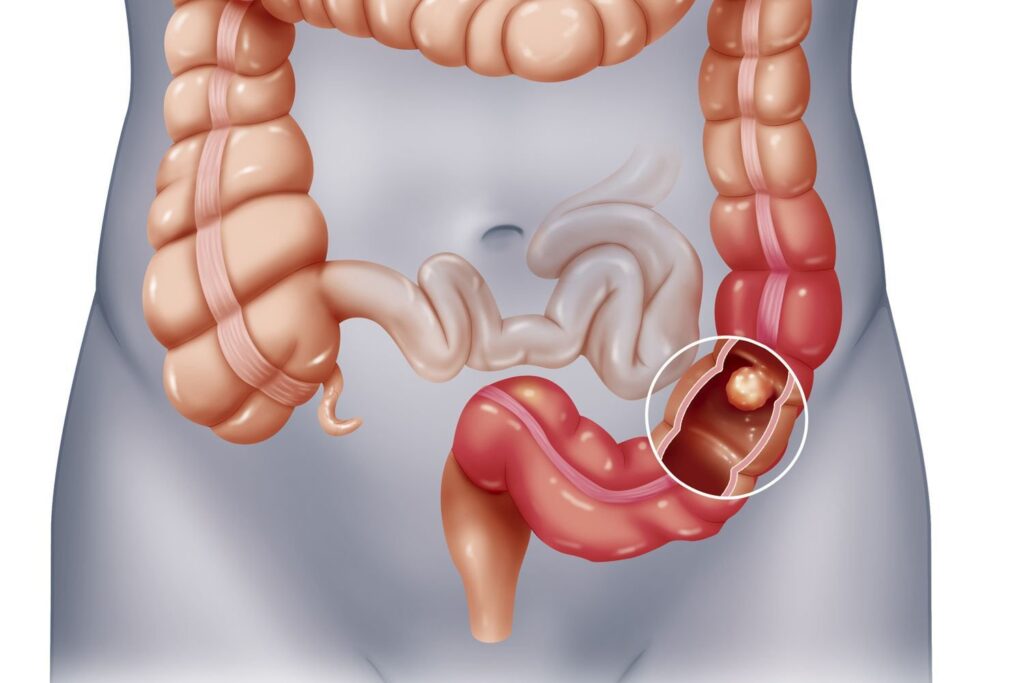 Ngải cứu giúp chống nhiễm trùng ký sinh