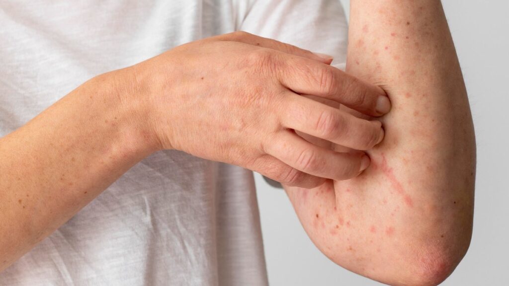 Hỗ trợ điều trị các triệu chứng viêm da 