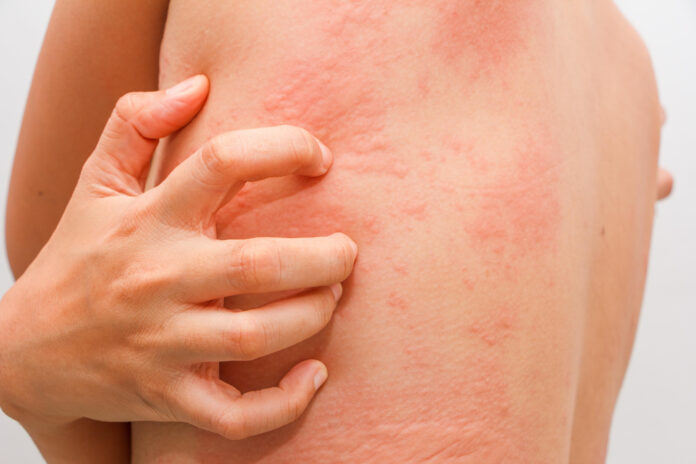bị dị ứng phải làm sao