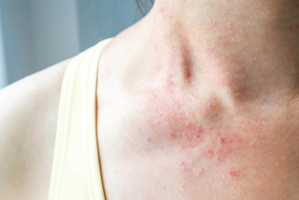 Atiso hỗ trợ điều trị dị ứng