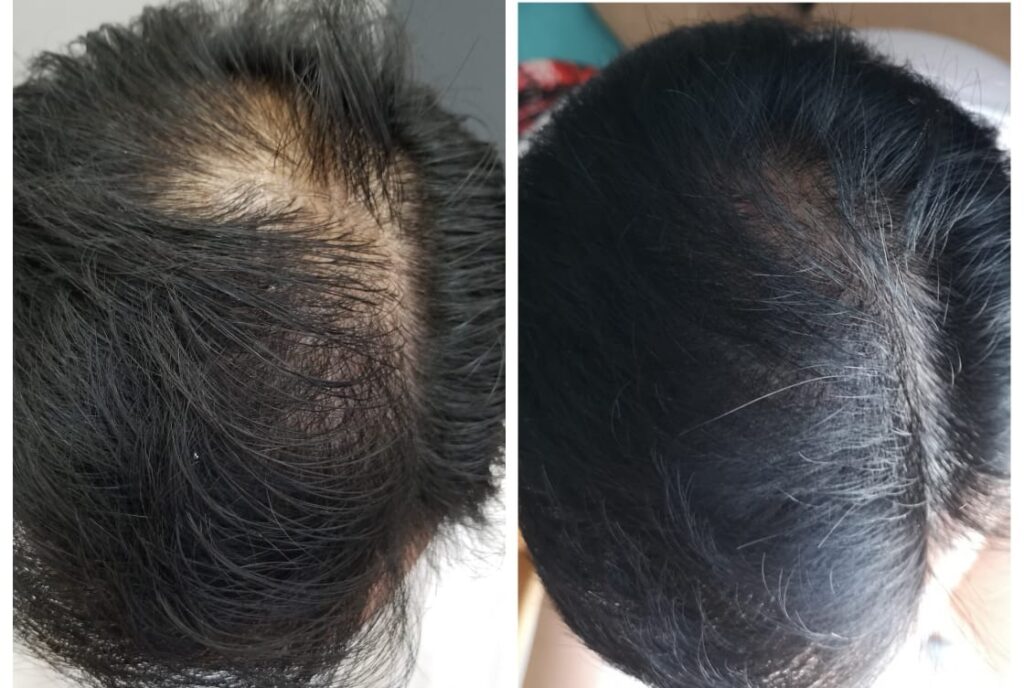 Massage đầu kích thích mọc tóc