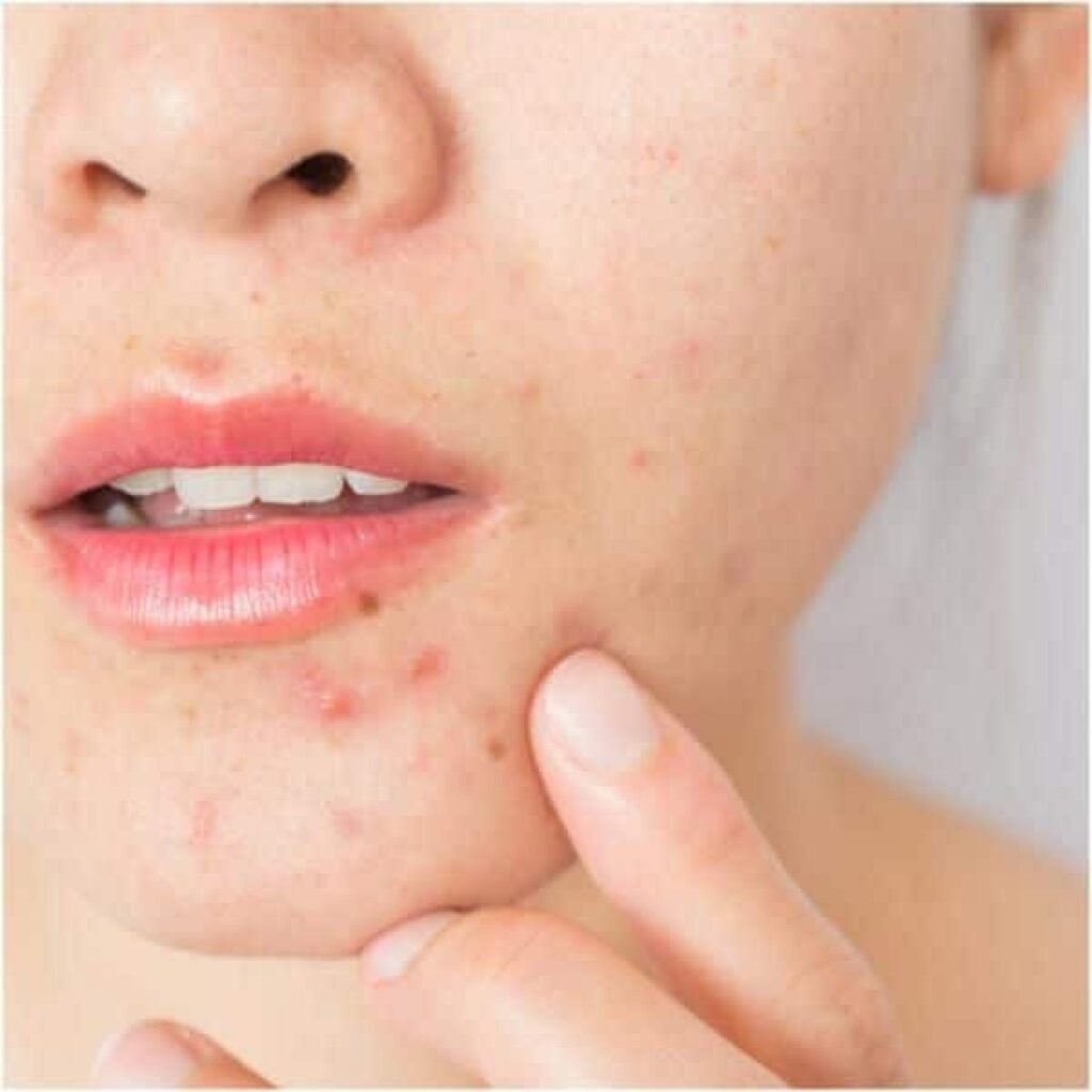 Tác dụng phụ của collagen