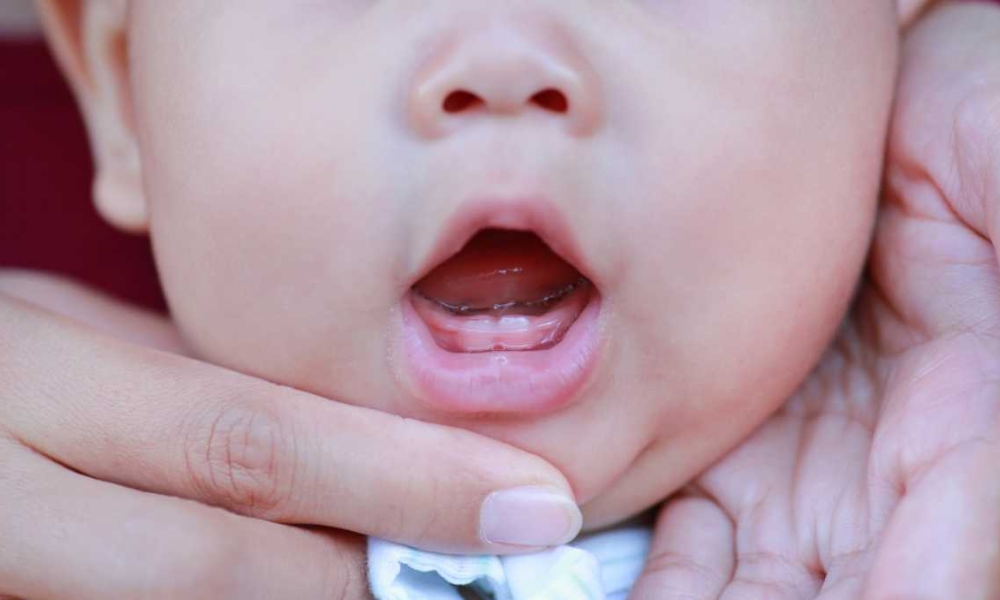 Răng sơ sinh là hiện tượng bình thường Răng sơ sinh là hiện tượng bình thường