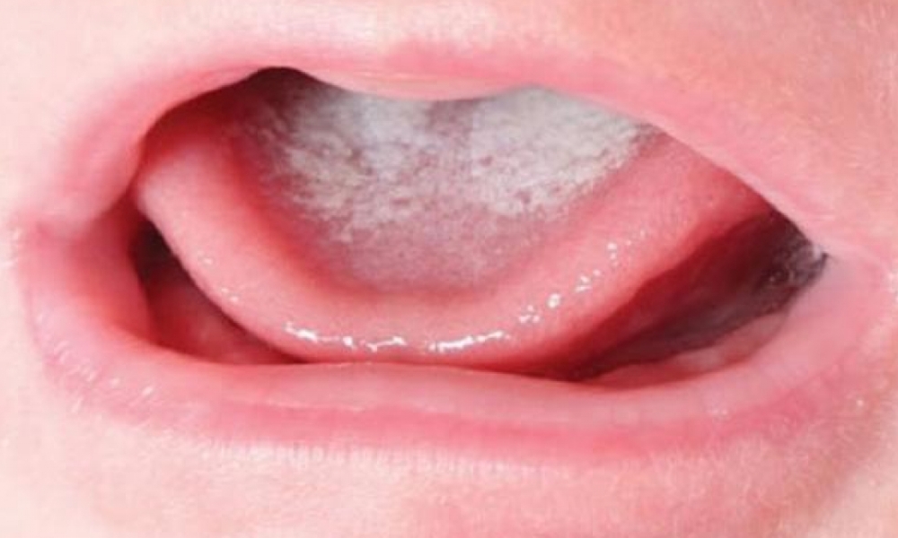 Biểu hiện của tưa miệng Biểu hiện của tưa miệng