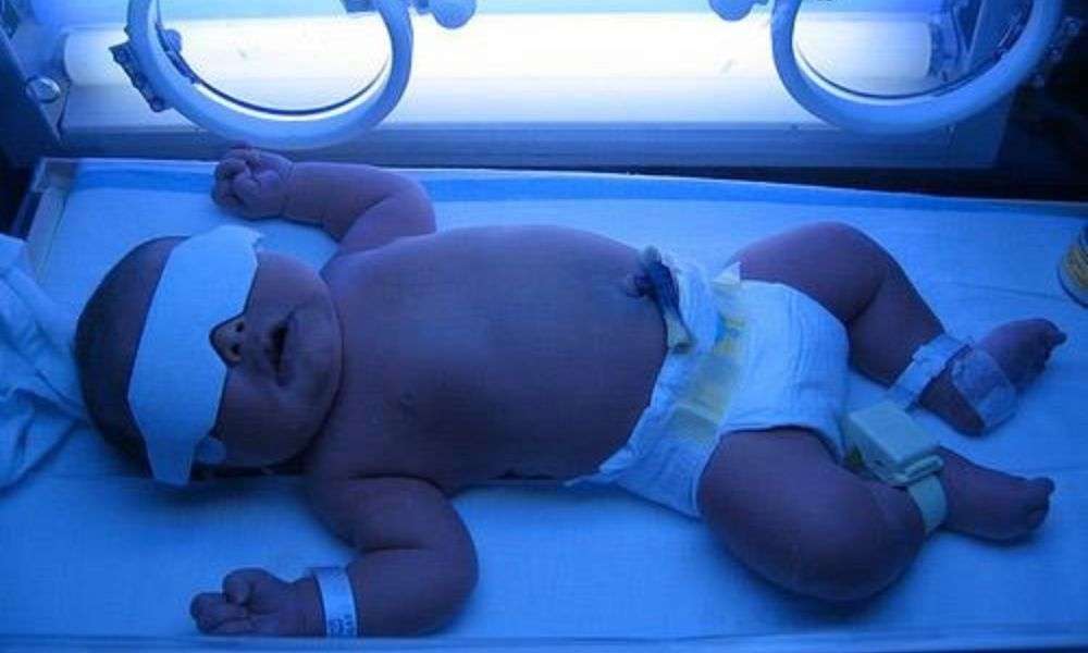 Sử dụng phương pháp chiếu đèn giúp chuyển hóa bilirubin giúp bé đào thải dễ hơn