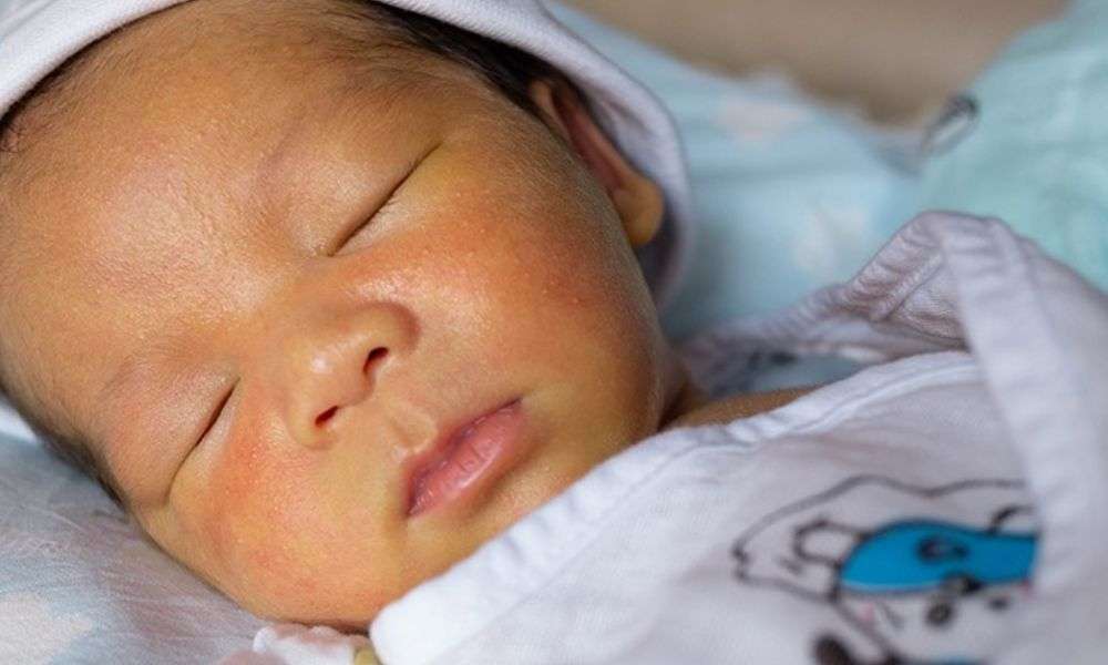 Da bé có dấu hiệu vàng đậm hơn và lan rộng xuống rốn và cả tay chân
