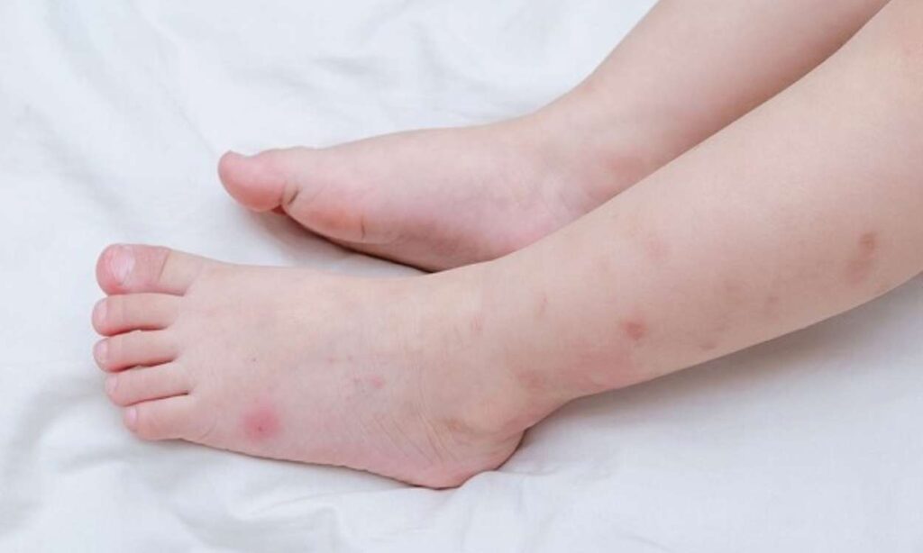 Trầy xước trên da nguyên nhân thường là do bé hay gãi ngứa Trầy xước trên da nguyên nhân thường là do bé hay gãi ngứa