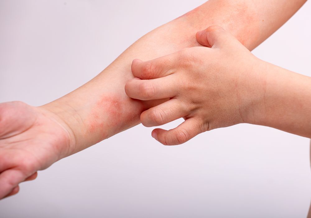 Sữa tắm điều trị viêm da có thể làm giảm kích ứng
