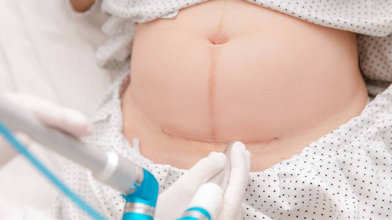 Phụ nữ sau sinh mổ cần ăn bánh chưng