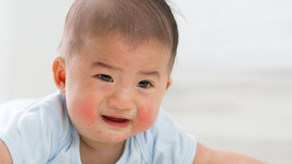 Bé bị nổi mề đay, khó thở hoặc chàm sữa bùng phát mạnh và lan rộng thì nên đi khám bác sĩ ngay
