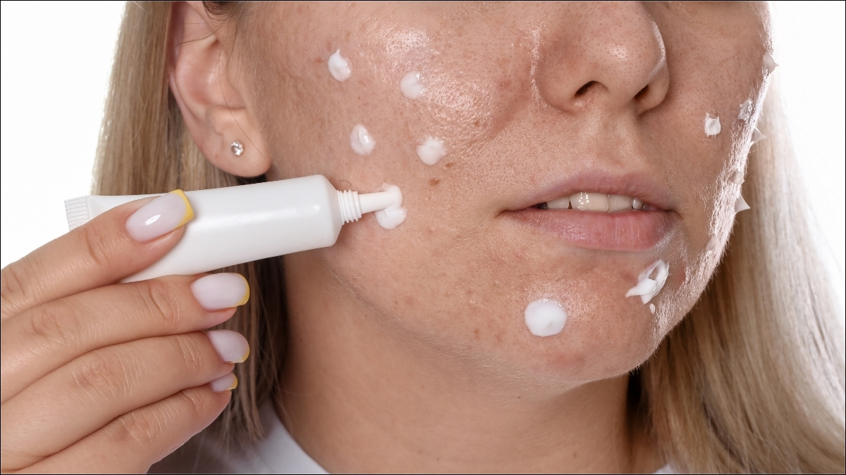Thành phần như Azelaic Acid và Niacinamide là lựa chọn an toàn để làm dịu da